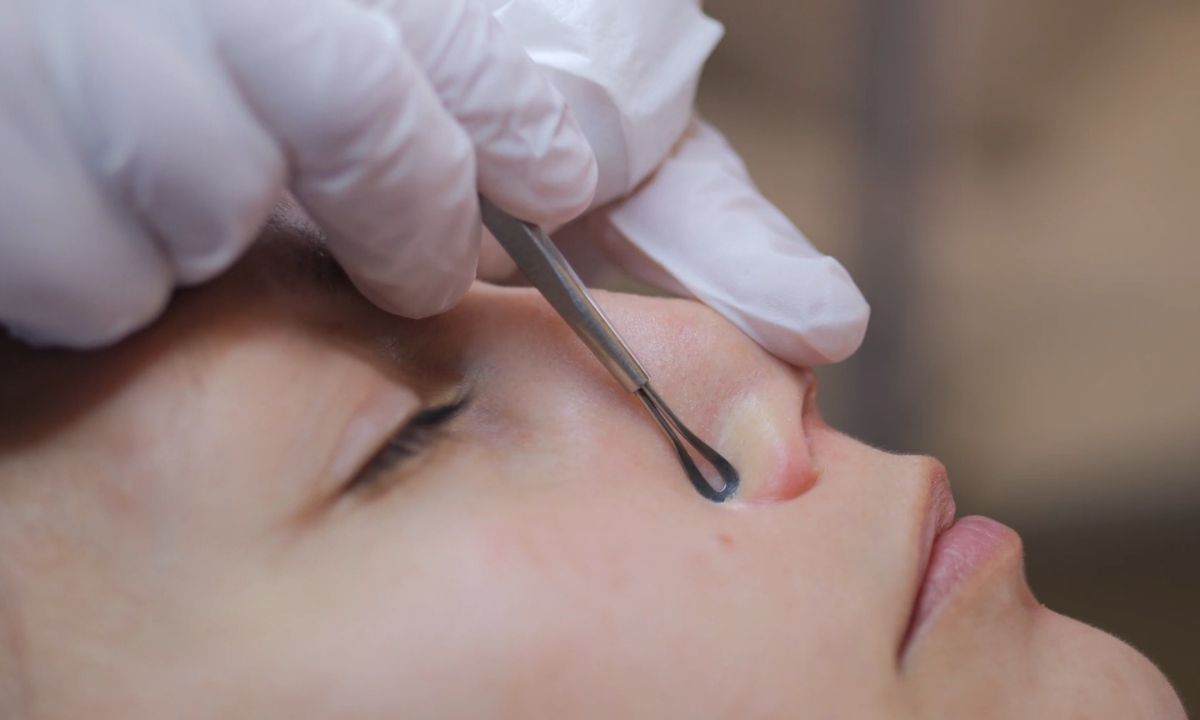 čišćenje lica od mitisera