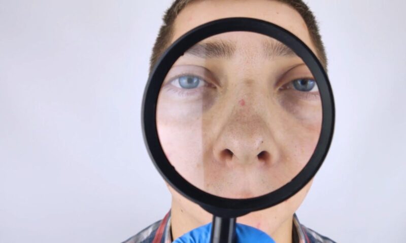 momak drži lupu i pokazuje mitisere na nosu