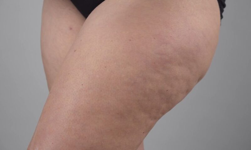 devojka pokazuje celulit na nogama